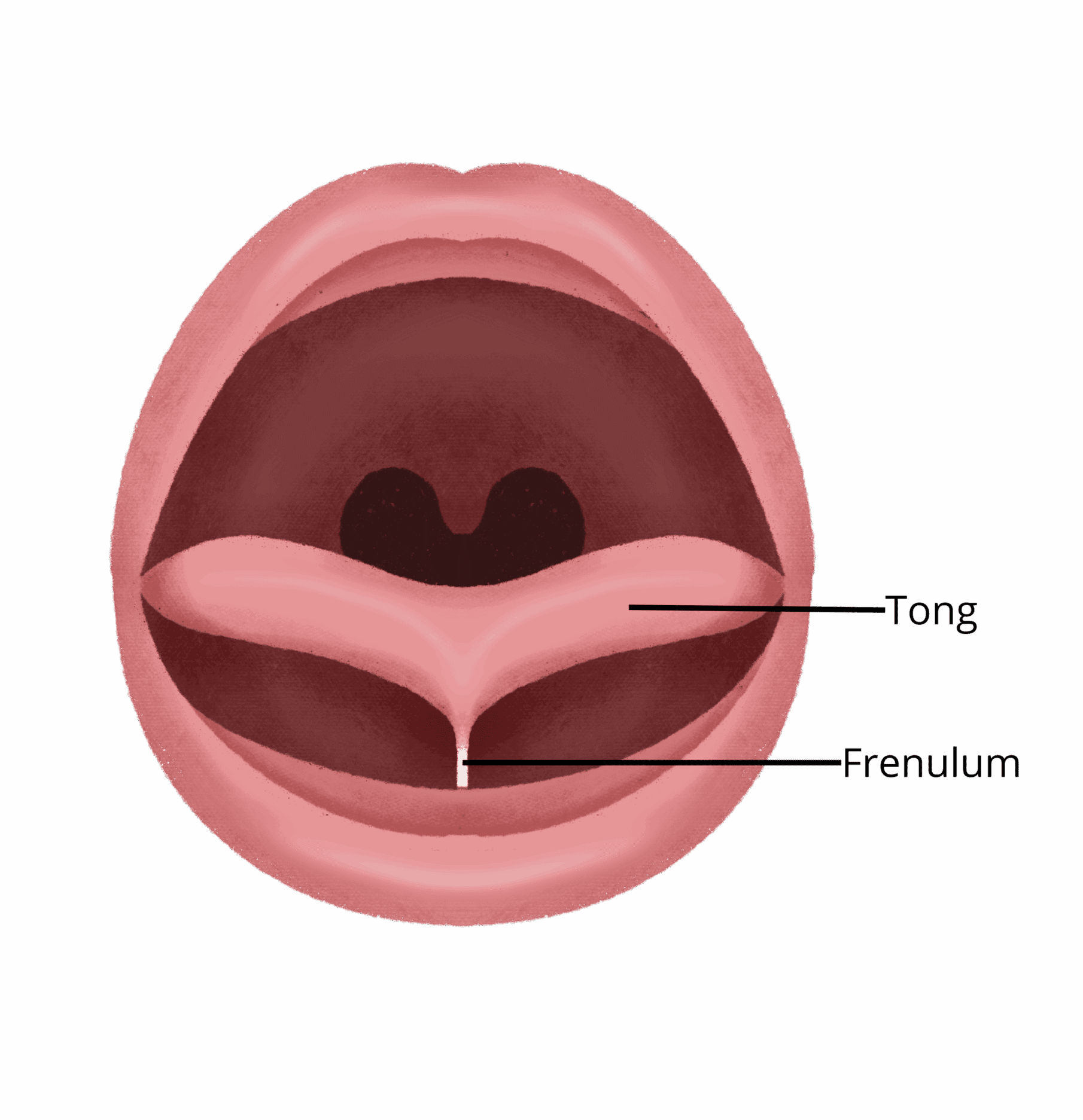 What is a short tongue tie (ankyloglossia - tongue tie)